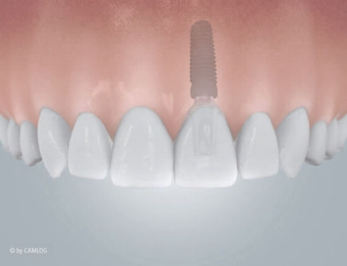 Implantat - Zahnarzt Martin Schaller in Plauen
