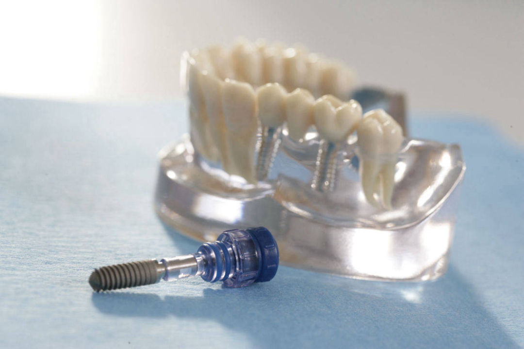 Implantate - Zahnarzt Martin Schaller in Plauen